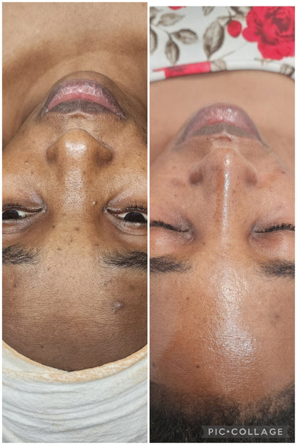 Clarifying & Blackhead Removing Acne treatment