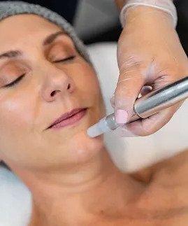 Microdermabrasion