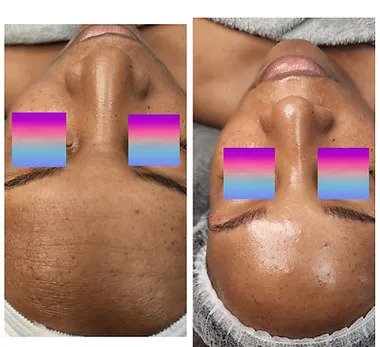 SWiCH Dermal Revitalization (Peel)