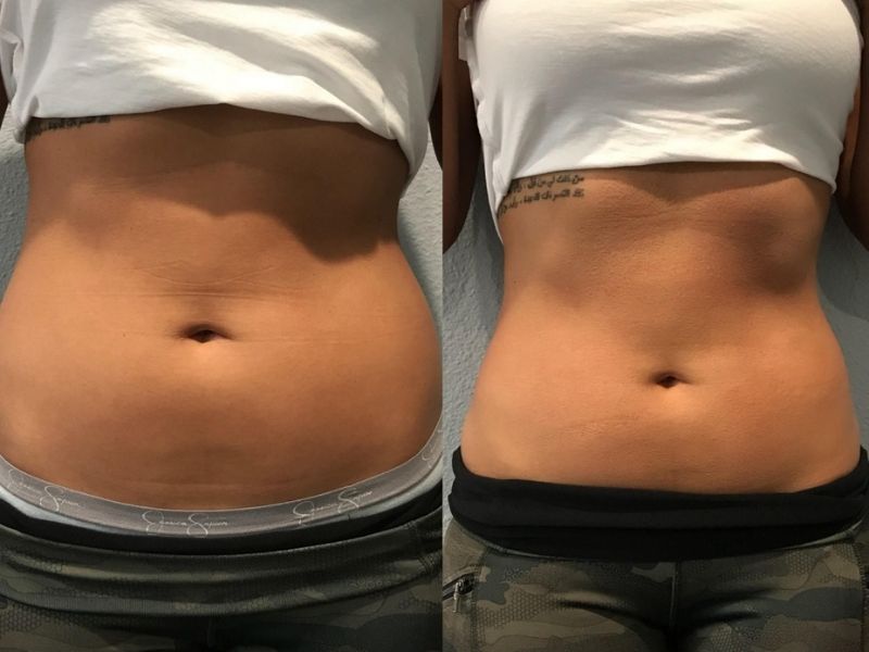 Fat Freezing/ Cryoslimming